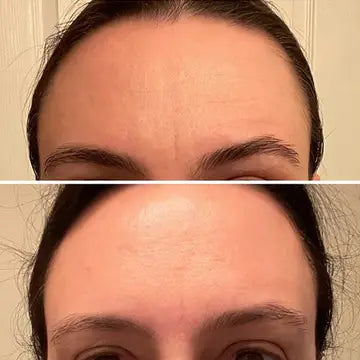 Forehead & Between Eyes Wrinkle Patches