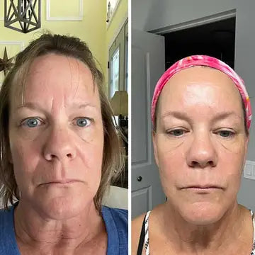 Forehead & Between Eyes Wrinkle Patches